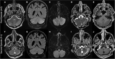 Hypomagnesemia-Induced Cerebellar Syndrome—A Distinct Disease Entity? Case Report and Literature Review